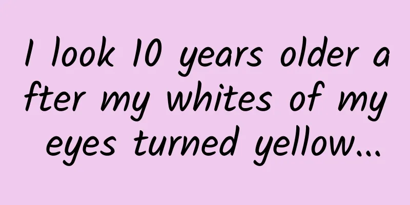 I look 10 years older after my whites of my eyes turned yellow...